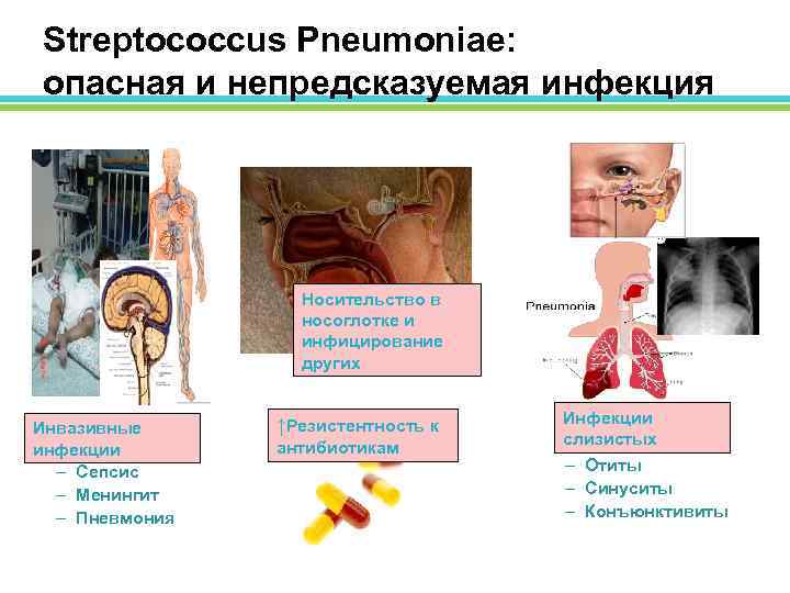Streptococcus Pneumoniae: опасная и непредсказуемая инфекция Носительство в носоглотке и инфицирование других Инвазивные инфекции