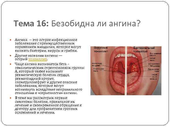 Тема 16: Безобидна ли ангина? Ангина ― это острое инфекционное заболевание с преимущественным поражением