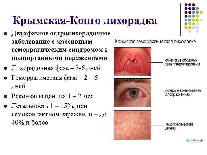 Крымская-Конго лихорадка l l l Двухфазное остролихорадочное заболевание с массивным геморрагическим синдромом и полиорганными