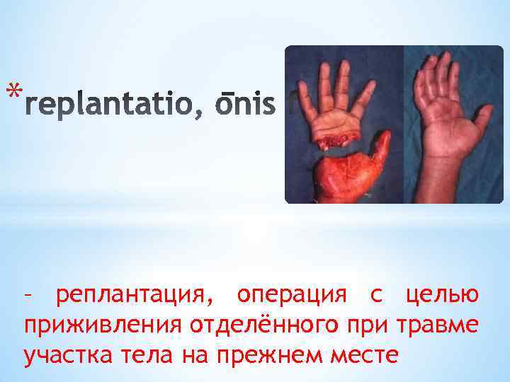 * – реплантация, операция с целью приживления отделённого при травме участка тела на прежнем