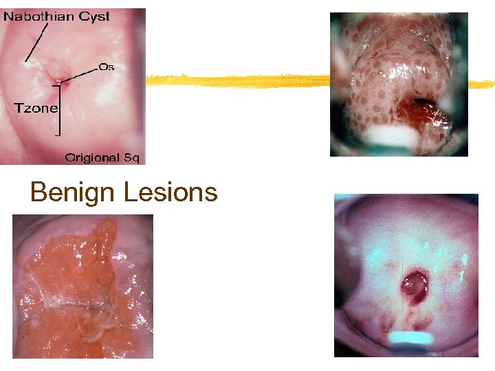 Benign Lesions 