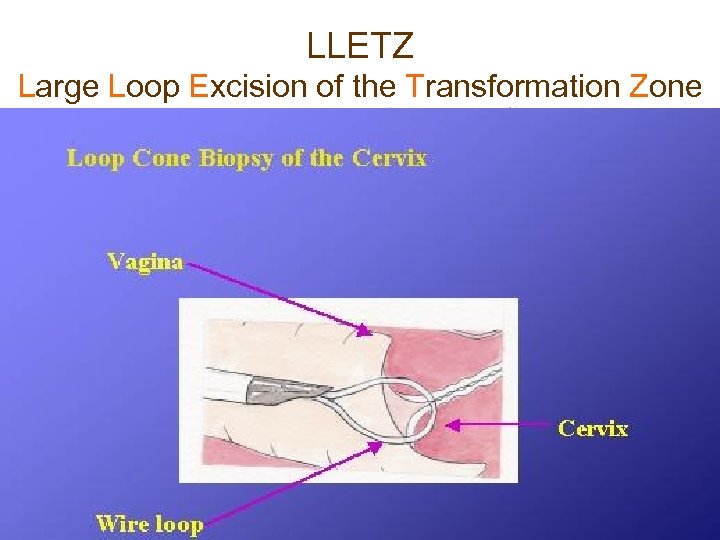 LLETZ Large Loop Excision of the Transformation Zone 