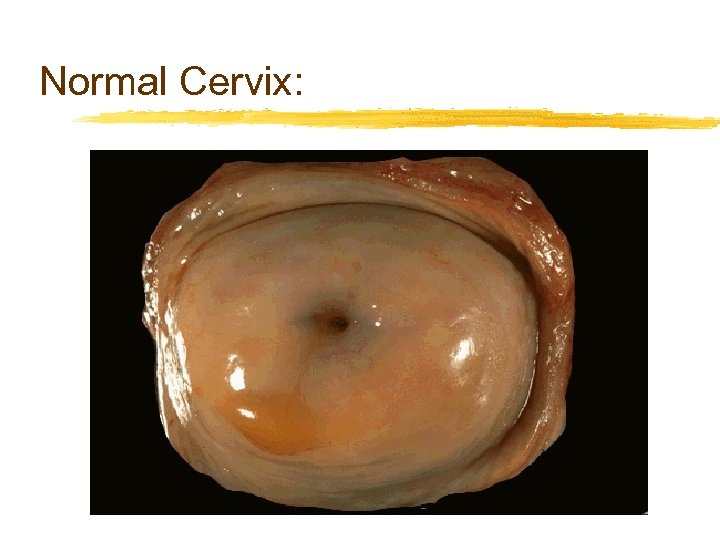 Normal Cervix: 
