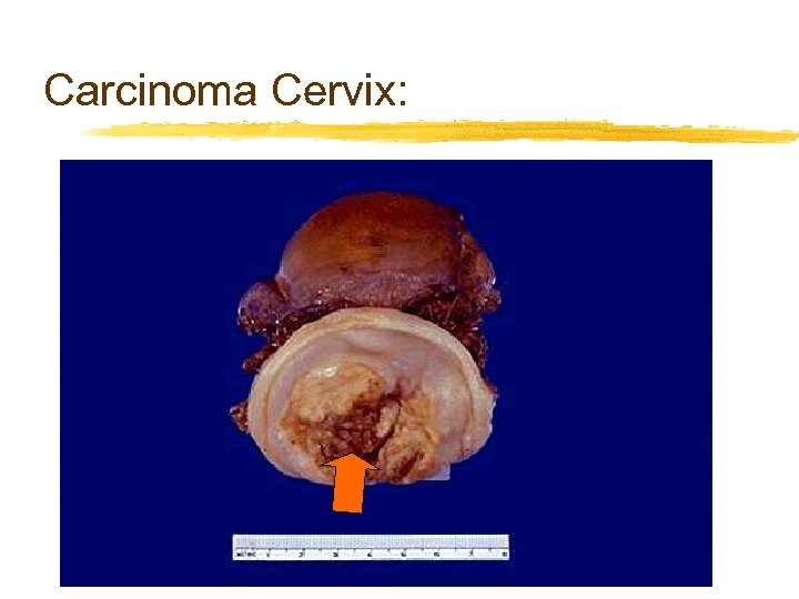 Carcinoma Cervix: 