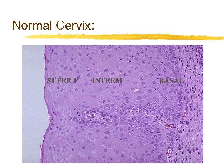 Normal Cervix: SUPER F INTERM BASAL 