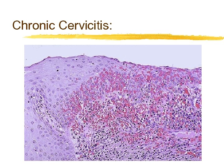 Chronic Cervicitis: 