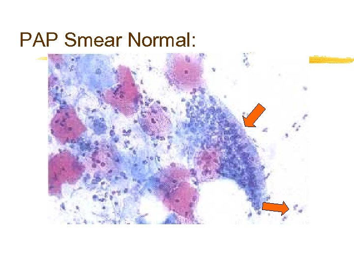 PAP Smear Normal: 
