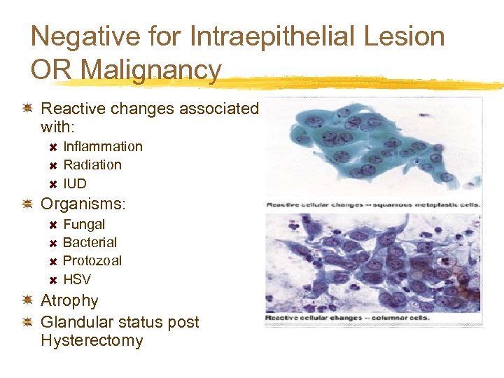 Negative for Intraepithelial Lesion OR Malignancy Reactive changes associated with: Inflammation Radiation IUD Organisms: