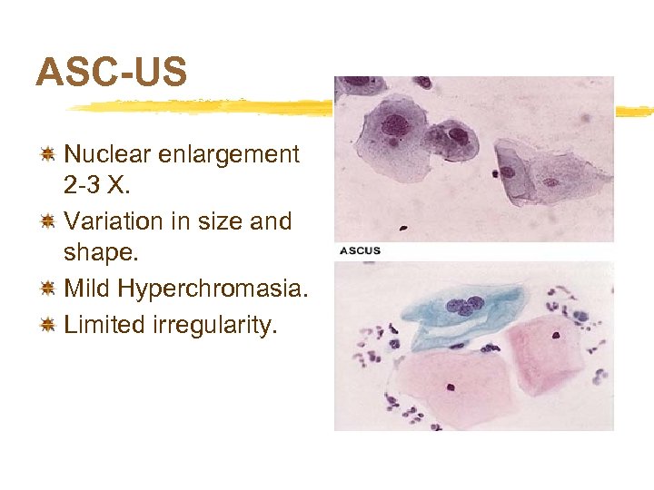 ASC-US Nuclear enlargement 2 -3 X. Variation in size and shape. Mild Hyperchromasia. Limited