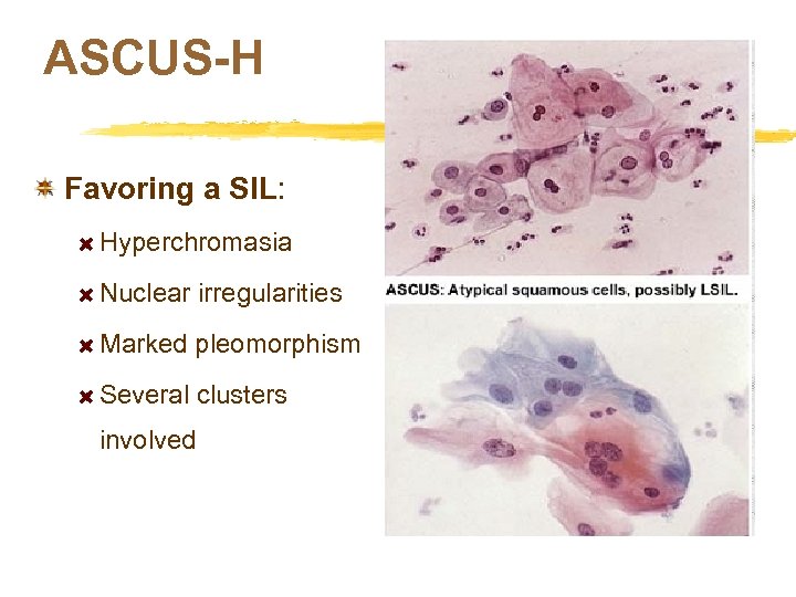 ASCUS-H Favoring a SIL: Hyperchromasia Nuclear irregularities Marked pleomorphism Several clusters involved 