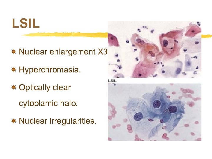 LSIL Nuclear enlargement X 3. Hyperchromasia. Optically clear cytoplamic halo. Nuclear irregularities. 