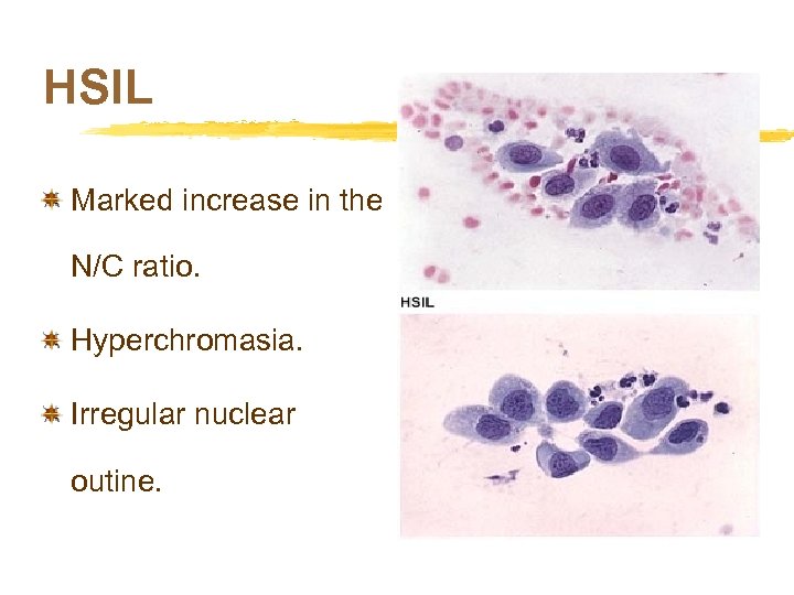 HSIL Marked increase in the N/C ratio. Hyperchromasia. Irregular nuclear outine. 