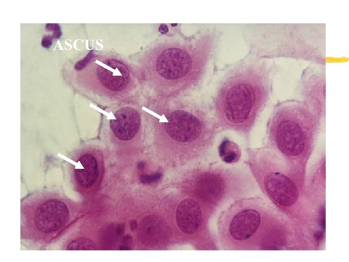 ASCUS 