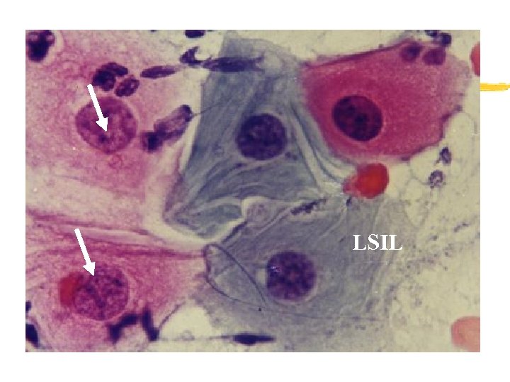 LSIL 