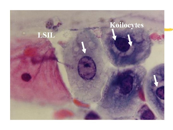 Koilocytes LSIL 