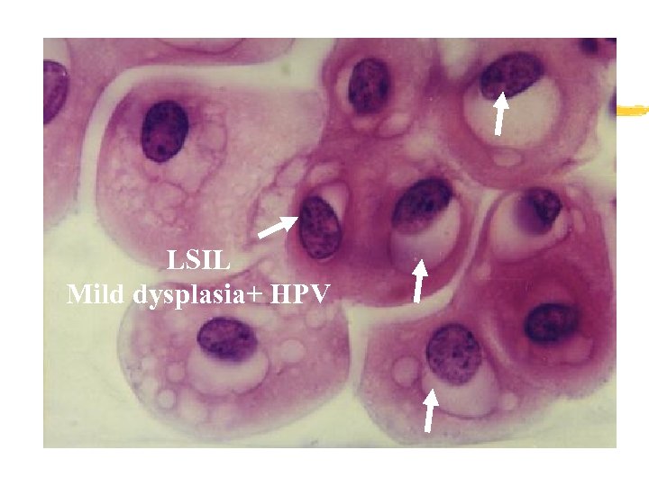 LSIL Mild dysplasia+ HPV 