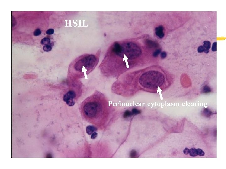 HSIL Perinuclear cytoplasm clearing 