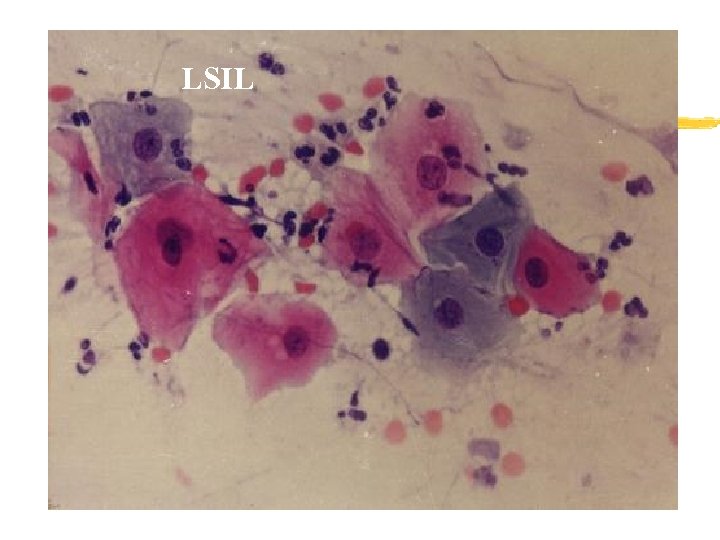 LSIL 