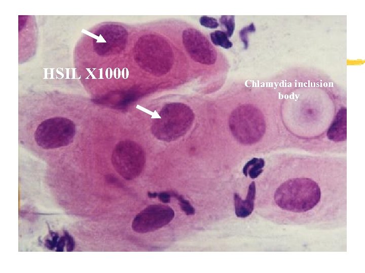 HSIL X 1000 Chlamydia inclusion body 