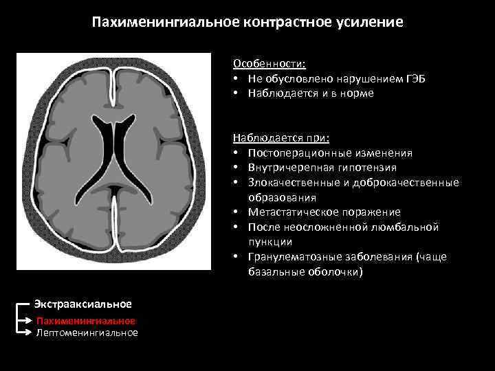 Пахименингиальное контрастное усиление Особенности: • Не обусловлено нарушением ГЭБ • Наблюдается и в норме