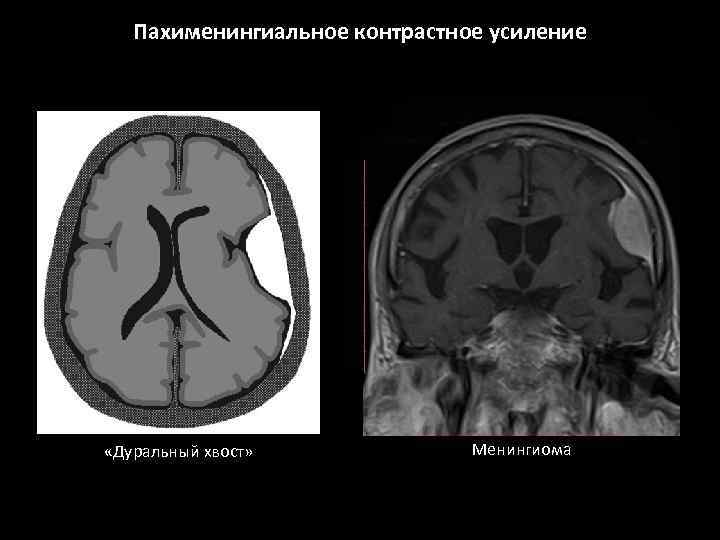 Пахименингиальное контрастное усиление «Дуральный хвост» Менингиома 