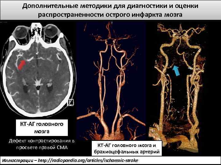 Дополнительные методики для диагностики и оценки распространенности острого инфаркта мозга КТ-АГ головного мозга Дефект