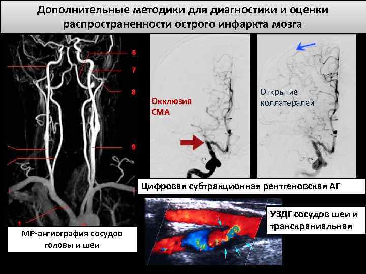 Дополнительные методики для диагностики и оценки распространенности острого инфаркта мозга Окклюзия СМА Открытие коллатералей