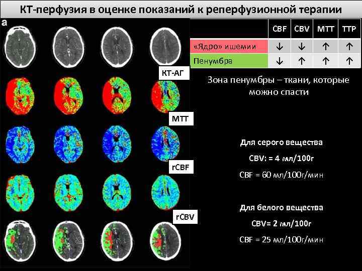 КТ-перфузия в оценке показаний к реперфузионной терапии CBF CBV MTT TTP «Ядро» ишемии ↓