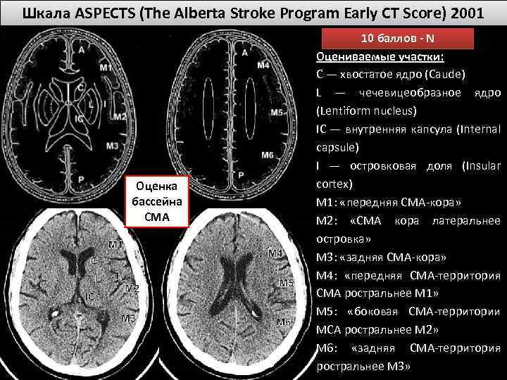 Шкала ASPECTS (The Alberta Stroke Program Early CT Score) 2001 Оценка бассейна СМА 10