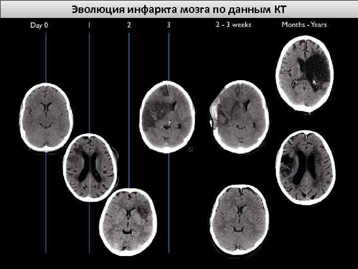 Эволюция инфаркта мозга по данным КТ 