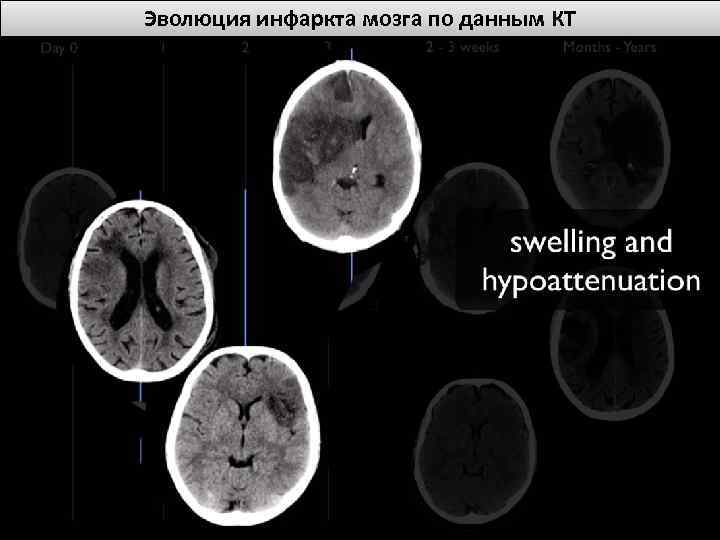 Эволюция инфаркта мозга по данным КТ 