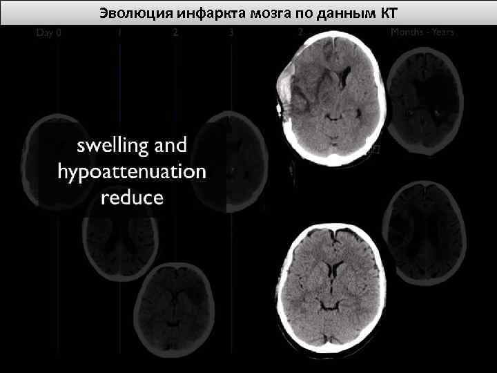Эволюция инфаркта мозга по данным КТ 