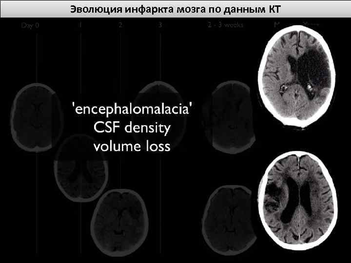 Эволюция инфаркта мозга по данным КТ 