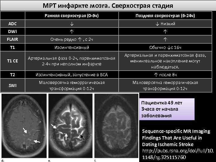 МРТ инфаркте мозга. Сверхострая стадия Ранняя сверхострая (0 -6 ч) Поздняя сверхострая (6 -24