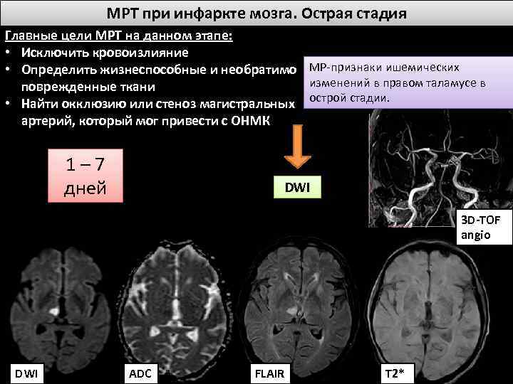 Мр картина множественных супратенториальных очагов хронической ишемии что это такое простыми словами