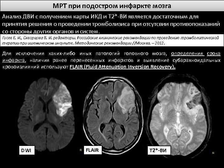 МРТ при подостром инфаркте мозга Анализ ДВИ с получением карты ИКД и T 2*-ВИ