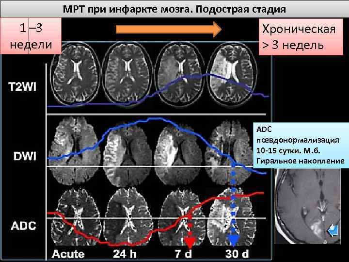 МРТ при инфаркте мозга. Подострая стадия 1 – 3 недели Хроническая > 3 недель