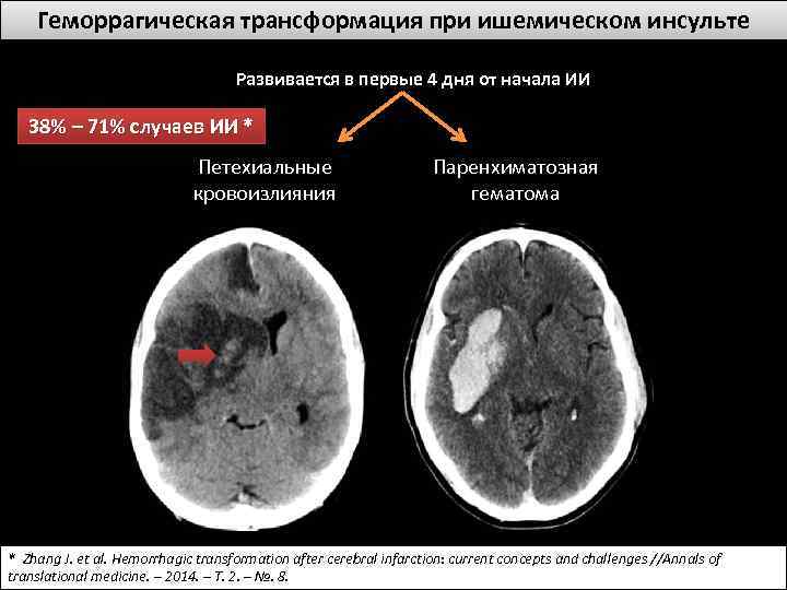 Геморрагическая трансформация при ишемическом инсульте Развивается в первые 4 дня от начала ИИ 38%