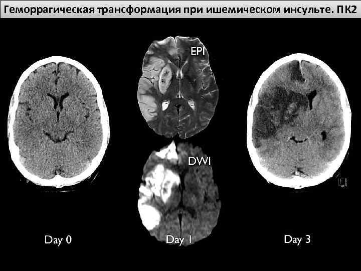Геморрагическая трансформация при ишемическом инсульте. ПК 2 