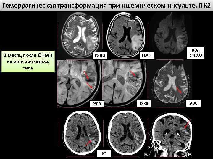 Карта смп инсульт