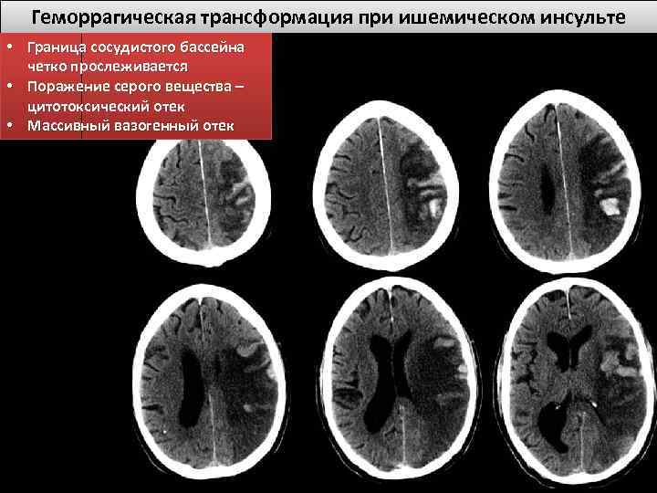 Геморрагическая трансформация при ишемическом инсульте • Граница сосудистого бассейна четко прослеживается • Поражение серого