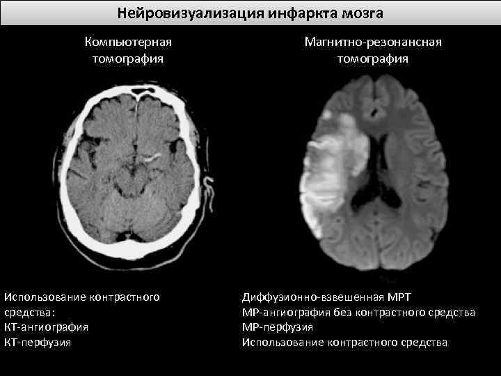Нейровизуализация инфаркта мозга Компьютерная томография Использование контрастного средства: КТ-ангиография КТ-перфузия Магнитно-резонансная томография Диффузионно-взвешенная МРТ