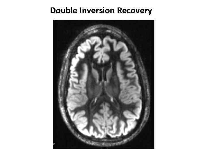 Double Inversion Recovery 