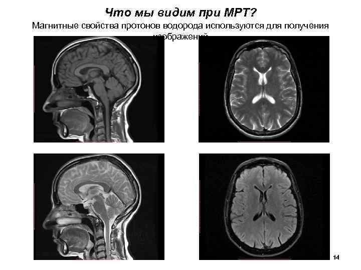 Что мы видим при МРТ? Магнитные свойства протонов водорода используются для получения изображений 14