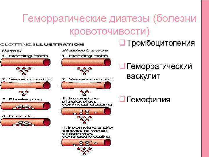 Геморрагический диатез