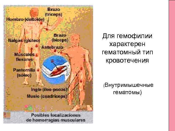 Для гемофилии характерен гематомный тип кровотечения (Внутримышечные гематомы) 