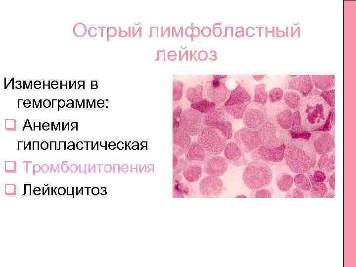 Лимфобластный лейкоз у взрослых
