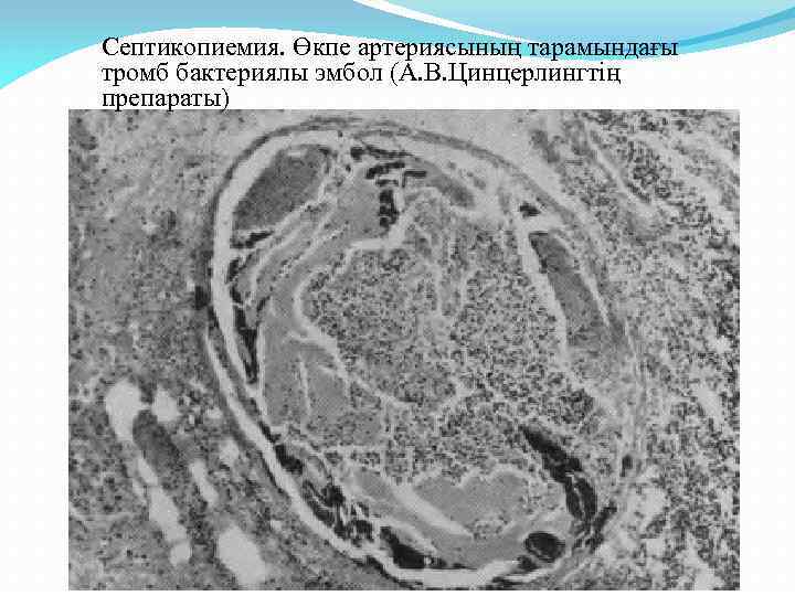 Септикопиемия. Өкпе артериясының тарамындағы тромб бактериялы эмбол (А. В. Цинцерлингтің препараты) 