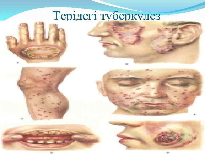 Терідегі туберкулез 