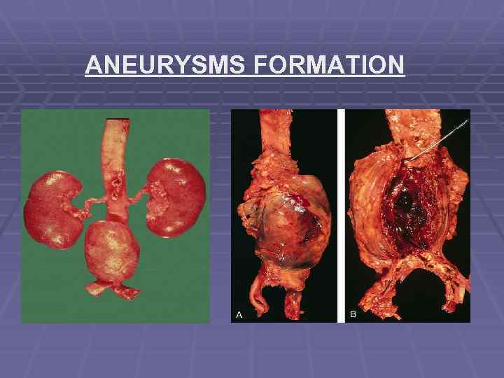ANEURYSMS FORMATION 